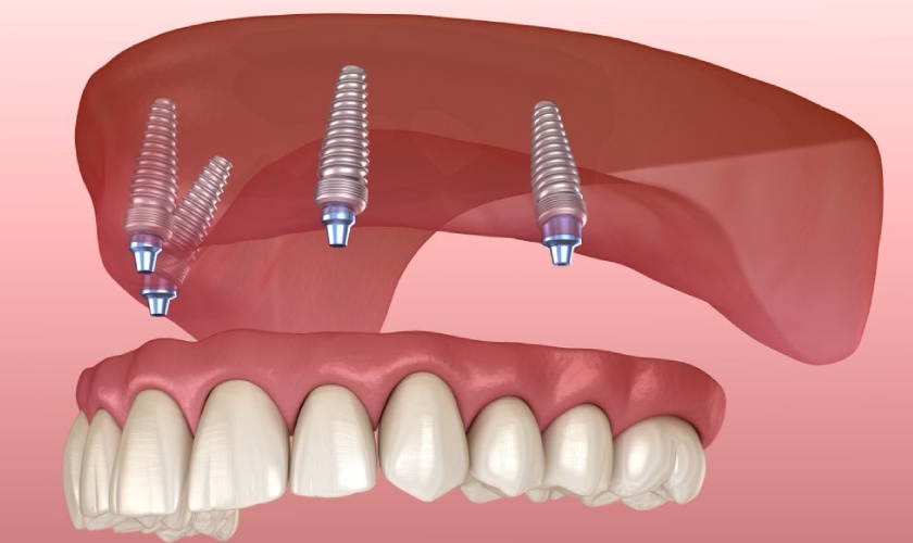 Kỹ thuật trồng răng Implant All-on-4 