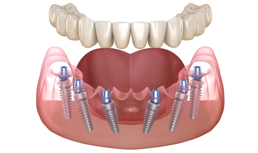 Kỹ thuật trồng Implant All-on-6