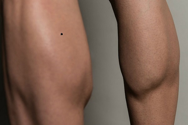 Nốt ruồi ở chân nam giới có ý nghĩa gì?