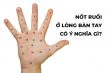 Nốt Ruồi Trong Lòng Bàn Tay Phải & Trái Ở Nam & Nữ Có Ý Nghĩa Gì?
